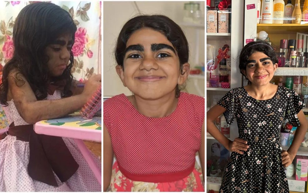 menina corpo cheio de pelos - foto